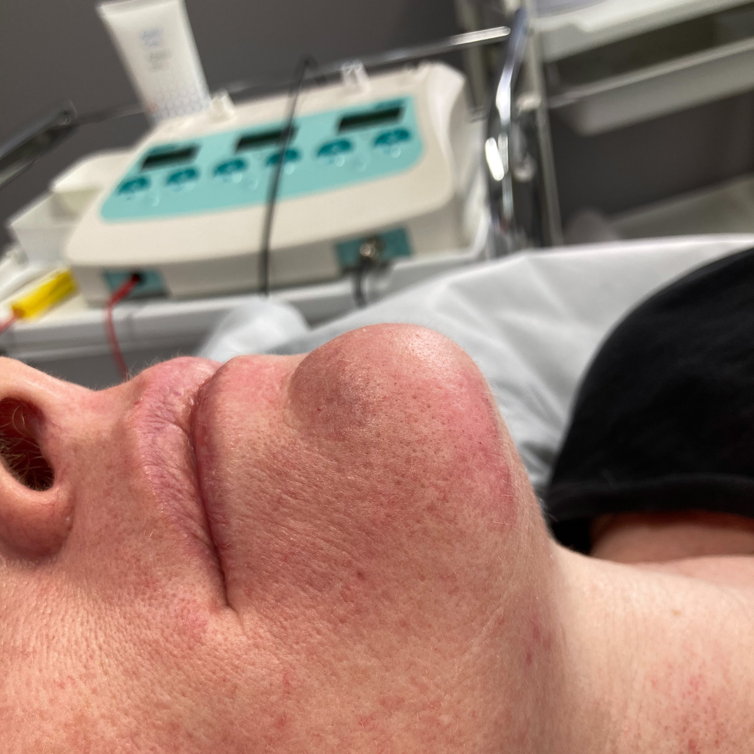 Electrolysis consultation for hormonal facial hair