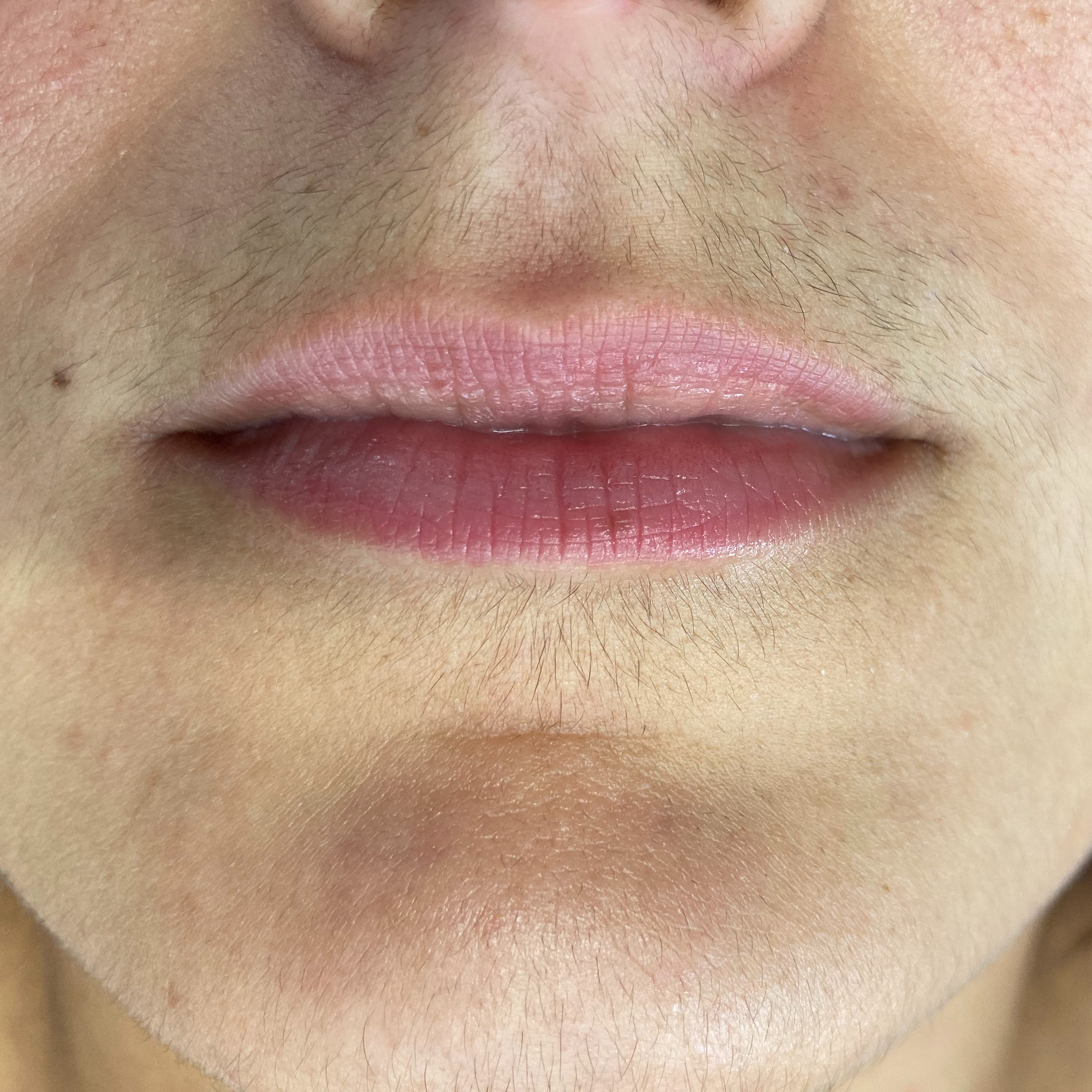 Woman learning about PCOS-related facial hair and electrolysis